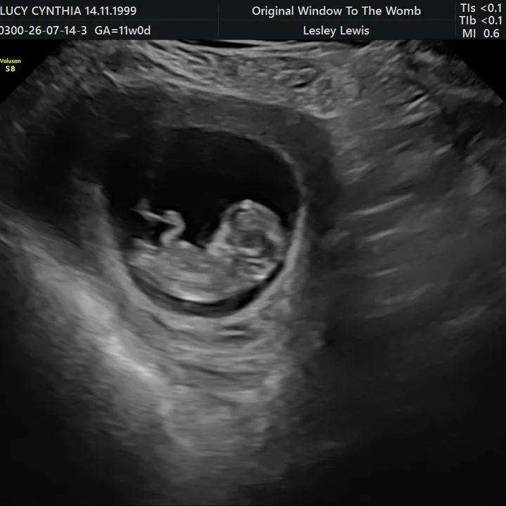 Early Pregnancy
